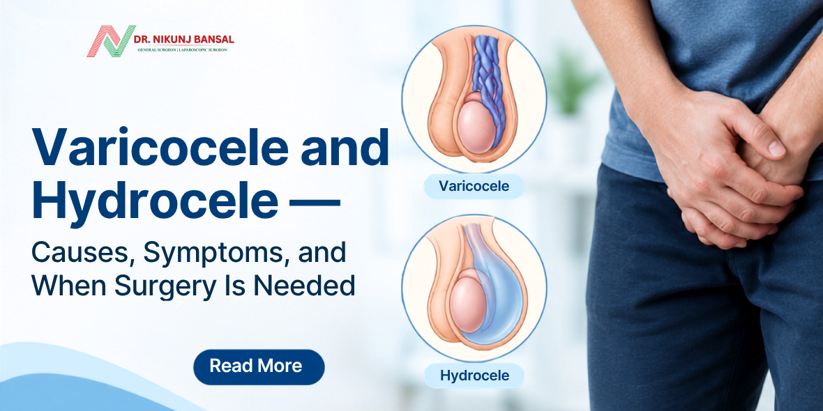 Varicocele and Hydrocele — Causes, Symptoms, and When Surgery Is Needed